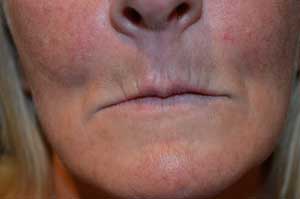 lines lip upper smokers filler dermal fillers dental care smoker before